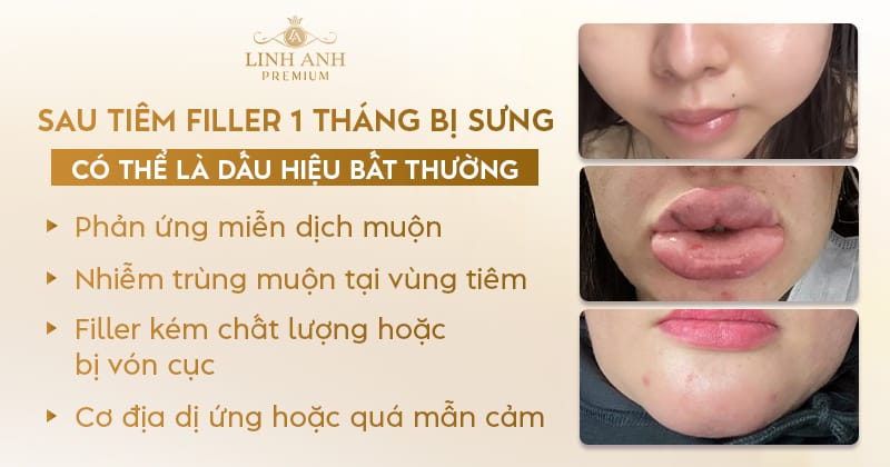 Lựa chọn filler nào và ảnh hưởng đến sưng như thế nào?