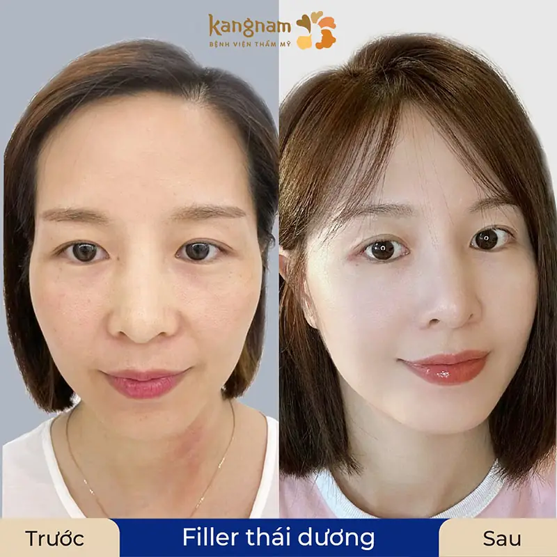 Những thương hiệu filler nên cân nhắc tại thị trường Việt Nam