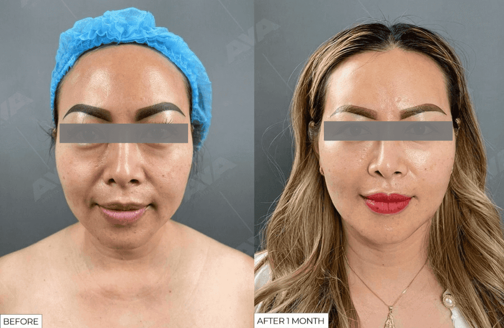 Quy trình tiêm filler an toàn tại clinic chuyên nghiệp diễn ra ra sao?