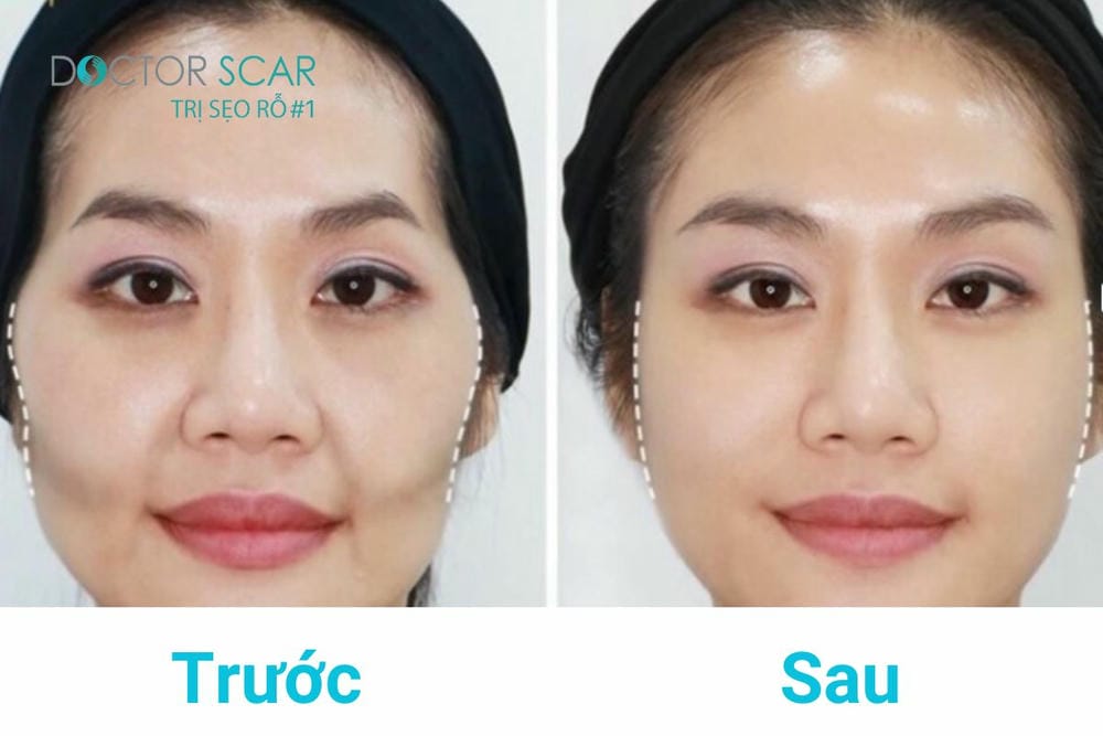Chăm sóc sau tiêm để tối ưu thời gian duy trì và giảm rủi ro — điều khách hàng thường bỏ qua?