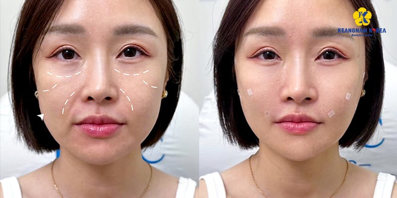 Làm sao để giảm tối đa rủi ro khi muốn tiêm filler?