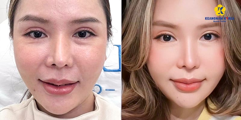Ai không nên tiêm filler hoặc cần thận trọng đặc biệt?