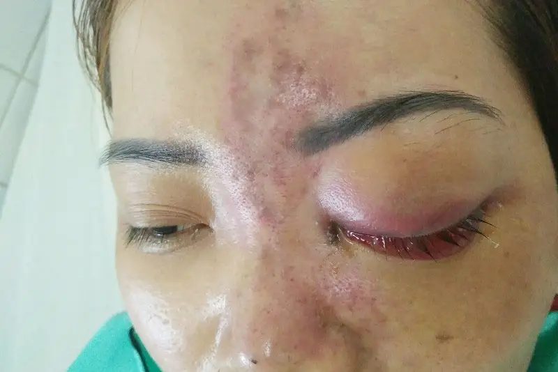 Biến chứng cấp cứu