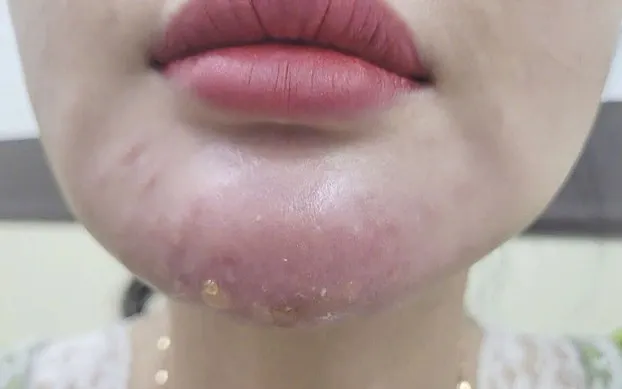 Ai có nguy cơ cao gặp sưng đau kéo dài hoặc biến chứng sau tiêm filler cằm?