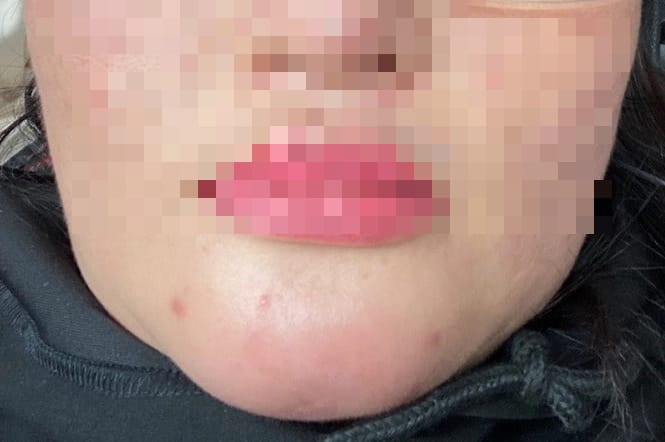 Tiêu chí để lựa chọn filler và nơi tiêm an toàn