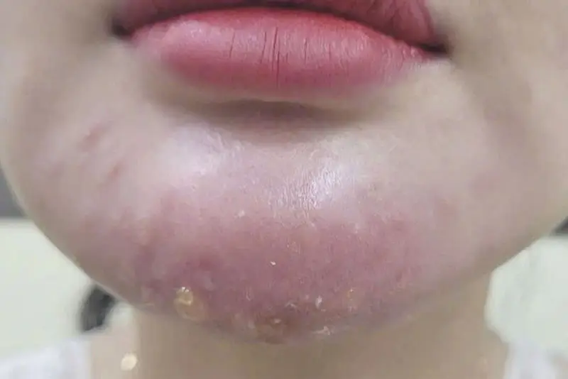 Tắc mạch do filler (vascular occlusion)