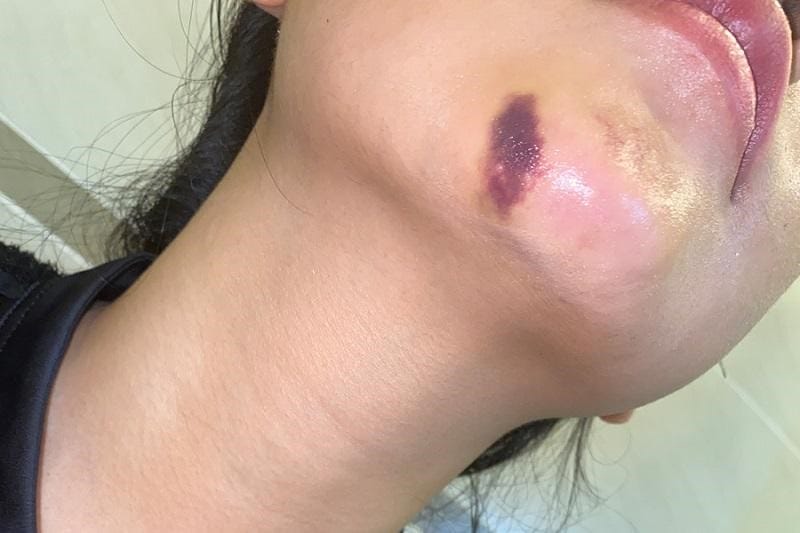 Nguyên nhân chính khiến cằm bị bầm sau tiêm filler là gì?