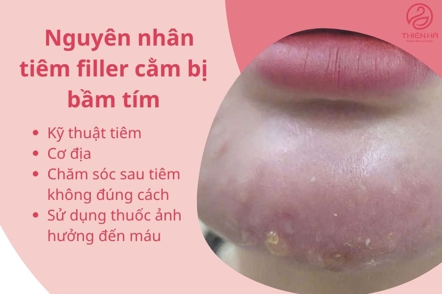 Khi nào không nên làm filler ngay?