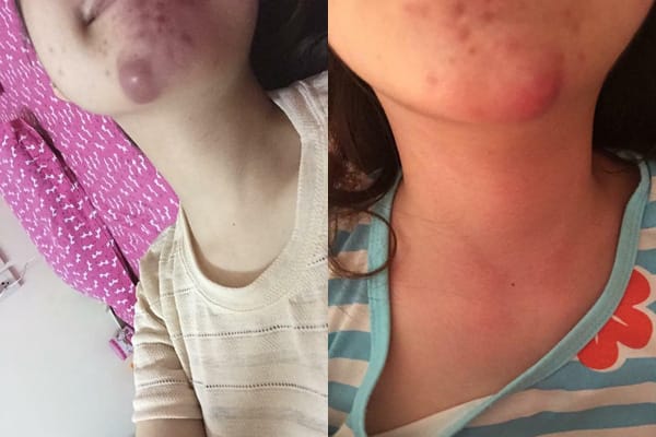 So sánh kim và cannula: phương pháp nào ít bị tím hơn cho cằm?