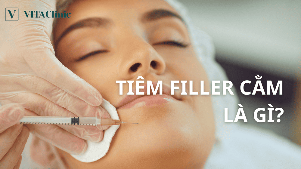 Filler cằm giữ được bao lâu?