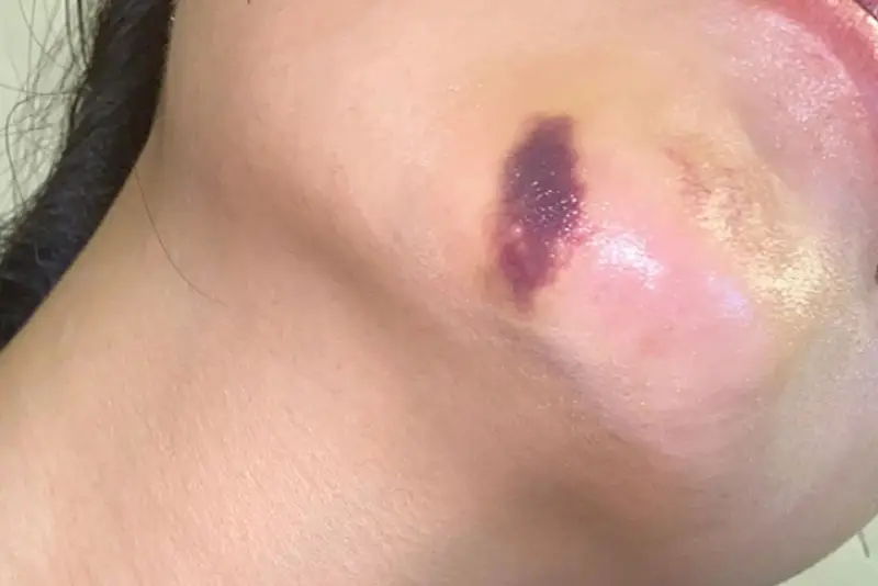 Tiêm filler cằm hay phẫu thuật nâng cằm: chọn phương án nào?