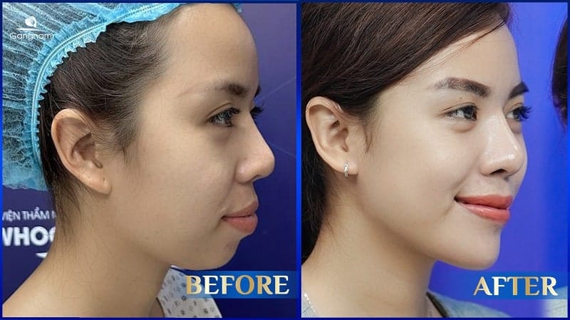 Tiêm filler cằm kết hợp chỉnh nha niềng răng, phẫu thuật chỉnh hàm như thế nào?