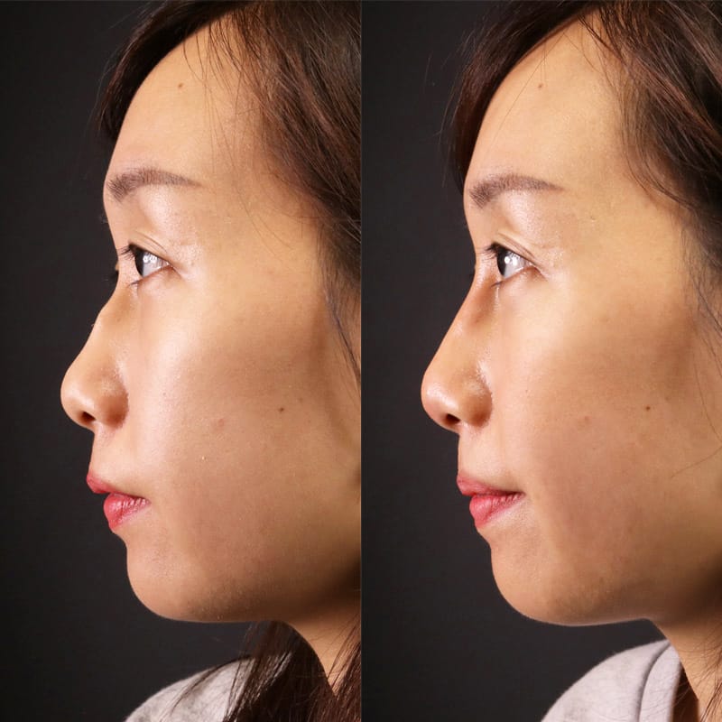 Rủi ro và biến chứng tiêm filler cằm — dấu hiệu cần tái khám khẩn cấp?