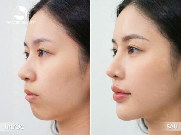 Tiêm filler cằm ở Lona Skin Lab — điều cần biết khi liên hệ tư vấn