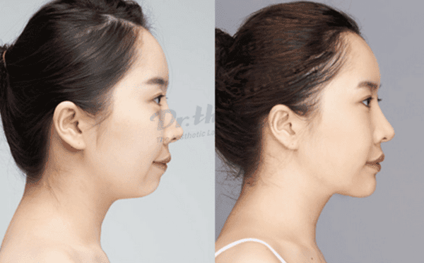 Chi tiết kỹ thuật (những lưu ý thực tế khi tiêm cằm)