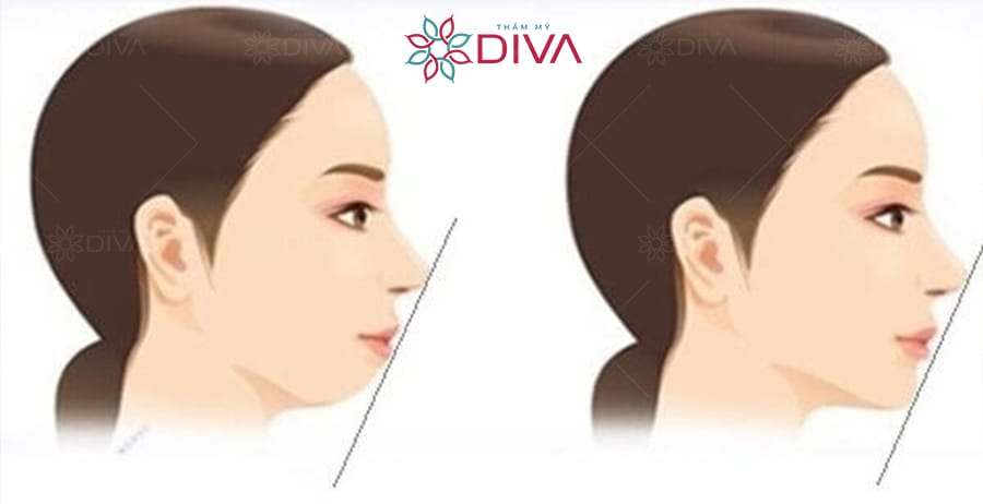 Nên tiêm bao nhiêu ml filler cằm cho cằm lẹm? Có giới hạn an toàn không?