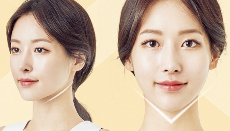 Làm thế nào mà filler lại thay đổi dáng cằm — cơ chế tác động?