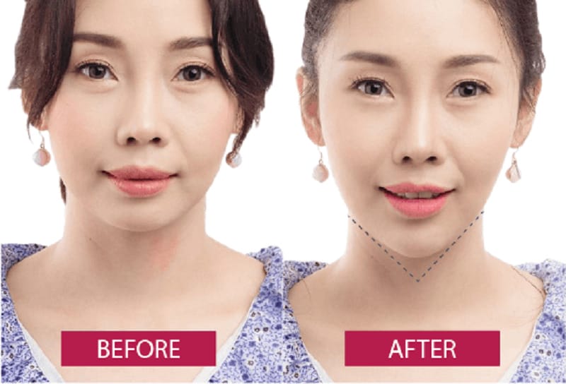 Làm sao để chọn cơ sở và bác sĩ đủ an toàn cho tiêm filler cằm V-line?