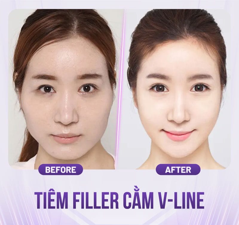 So sánh: tiêm filler cằm V-line vs độn cằm phẫu thuật — chọn thế nào?
