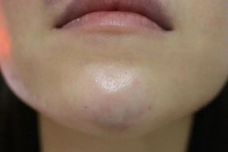Quy trình an toàn khi tiêm filler cứng — cần hỏi bác sĩ những gì?