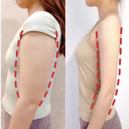 Ai phù hợp và ai không phù hợp để lựa chọn tiêm tan mỡ cho bắp tay?