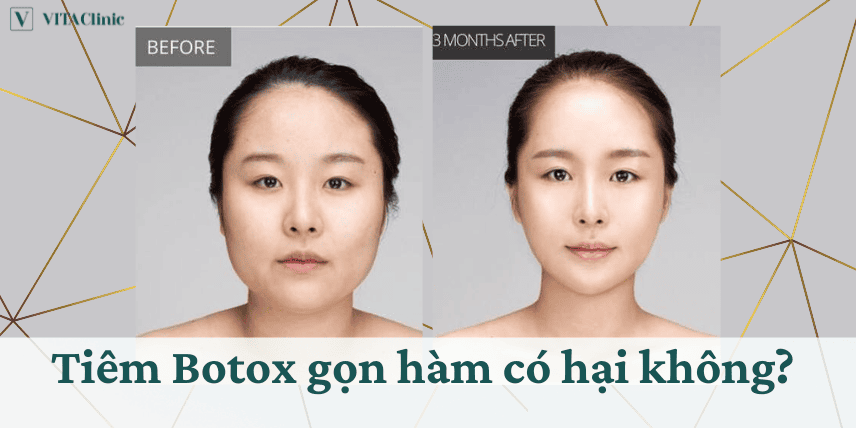 Nên chọn loại filler nào cho gọn hàm — Vivacy, Opera, Aileene và ưu tiên ra sao?