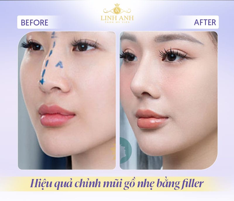 Yếu tố nào quyết định ai phù hợp để tiêm filler gốc mũi?