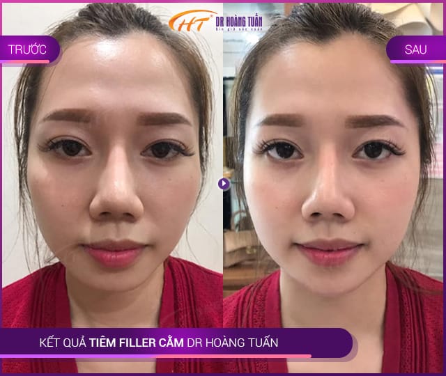 Quy trình tiêm filler an toàn — từng bước cần biết?