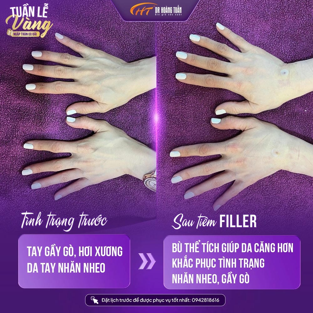 Chăm sóc sau tiêm filler — cần lưu ý gì để tối ưu kết quả và giảm rủi ro?