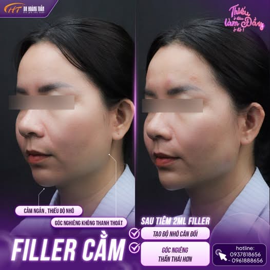 Tiêm filler ở đâu an toàn — những tiêu chí để lựa chọn cơ sở?