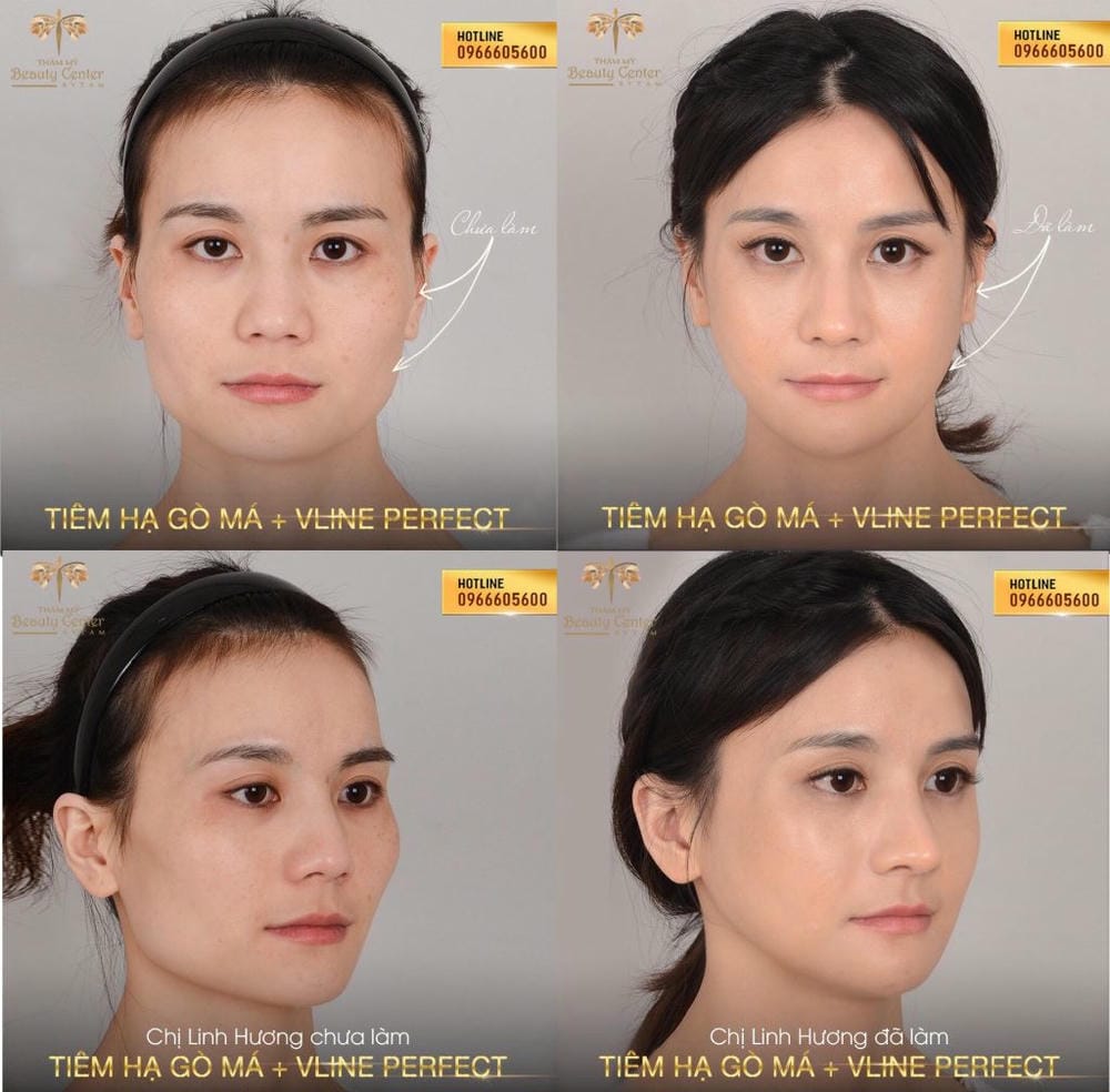 Tại sao hyaluronic acid tạo hiệu ứng hạ gò má — cơ chế tác dụng ra sao?