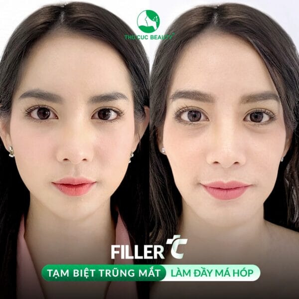 Tiêm filler của hãng nào phù hợp cho vùng gò má — có những lựa chọn nào ở thị trường Việt Nam?