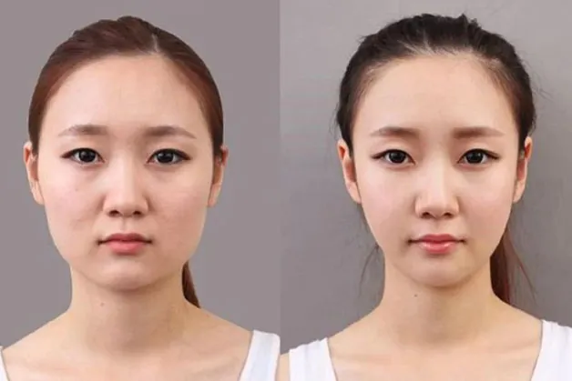So sánh: tiêm filler hạ gò má vs phẫu thuật nâng gò má hoặc cấy mỡ