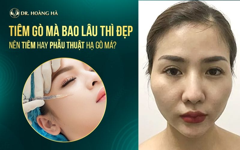 Quy trình tiêm filler hạ gò má an toàn — các bước cần có