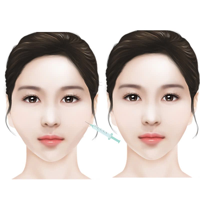 Kỹ thuật an toàn — cannula hay kim?