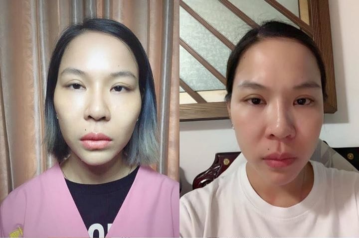 Làm sao để chọn nơi tiêm filler hạ gò má an toàn ở Việt Nam?