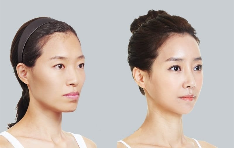 Kết thúc và bước tiếp theo nếu đang cân nhắc tiêm filler hạ gò má