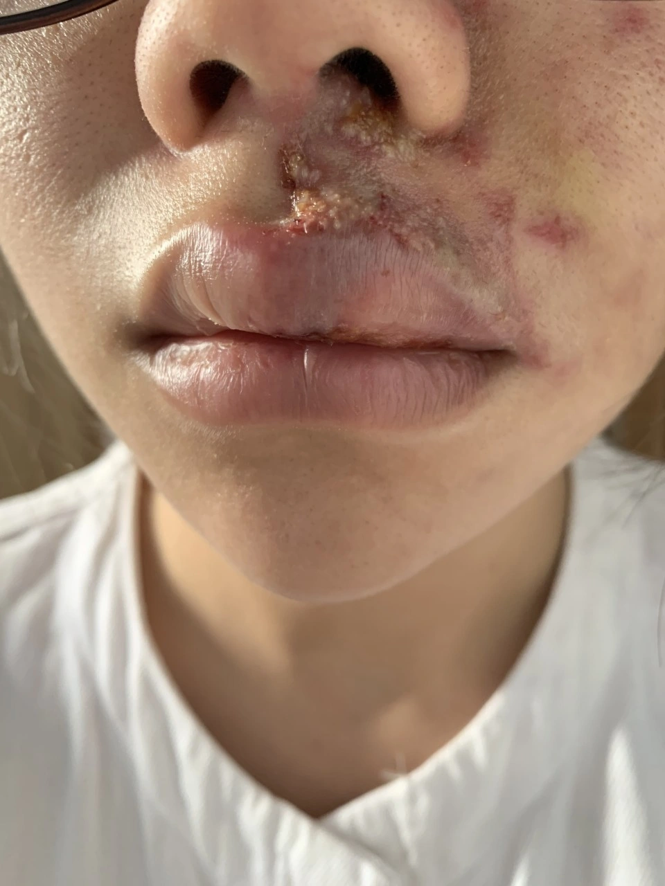 Nguyên nhân nào khiến tiêm filler hỏng — cơ chế tắc mạch, dị ứng hay nhiễm khuẩn?
