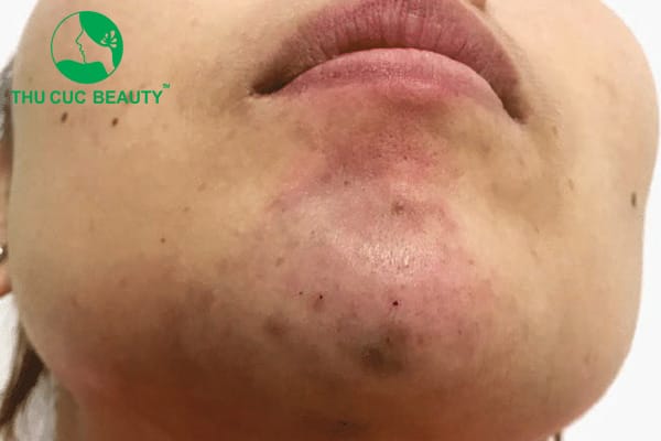 Trong trường hợp tắc mạch do HA filler, có thể làm gì — liệu hyaluronidase có phải “cứu tinh”?