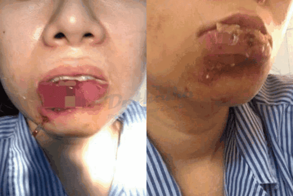 So sánh các lựa chọn: tiêm tan, phẫu thuật, laser và liệu pháp phục hồi thẩm mỹ da — ưu nhược điểm?