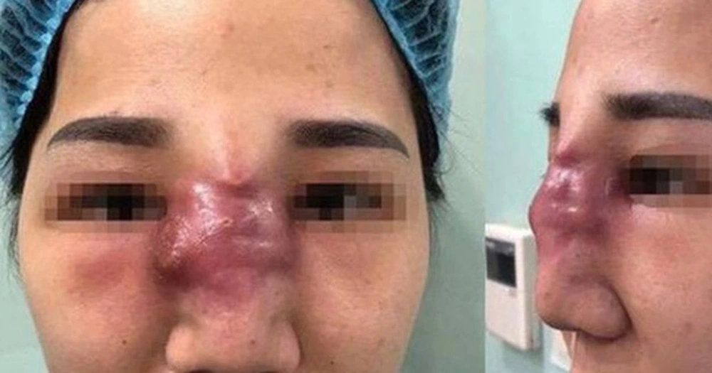 Lưu ý chăm sóc sau xử lý và những chống chỉ định thường gặp