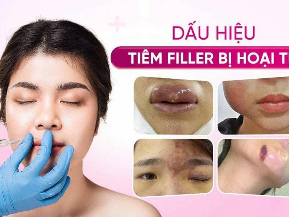 Làm sao giảm rủi ro trước khi quyết định tiêm filler lần hai?