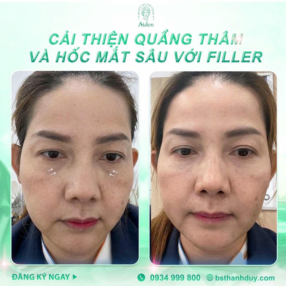Tại sao hốc mắt lõm khiến gương mặt mệt mỏi — và tiêm filler có giúp được không?