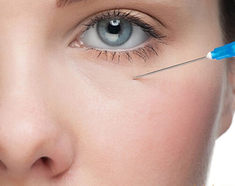 Quy trình tiêm filler hốc mắt an toàn diễn ra như thế nào?