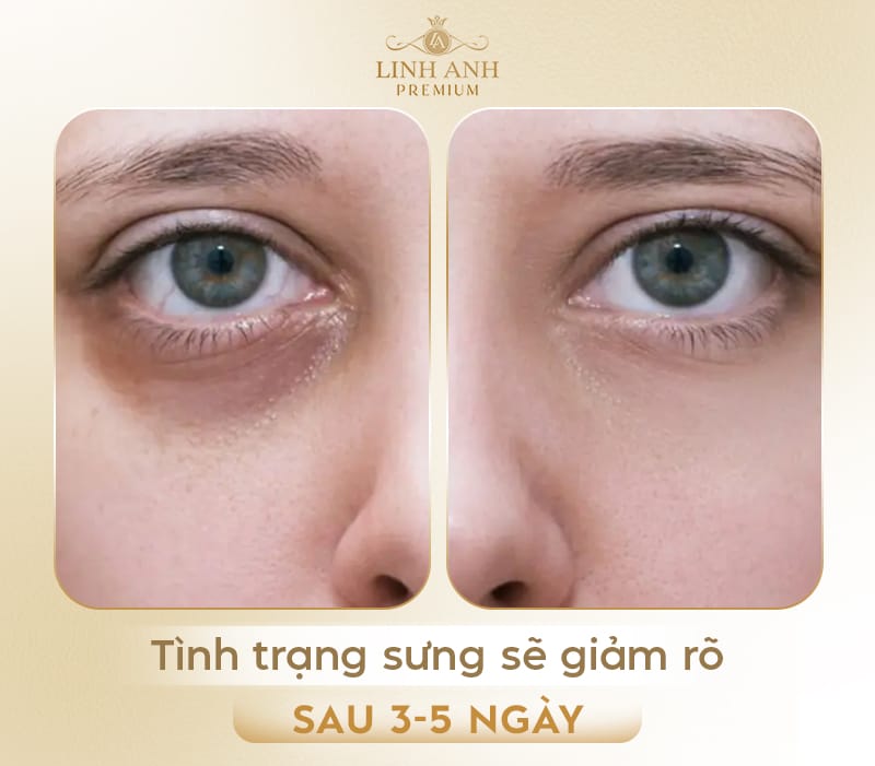 Tại sao hốc mắt bị sưng sau khi tiêm filler — có phải bình thường không?