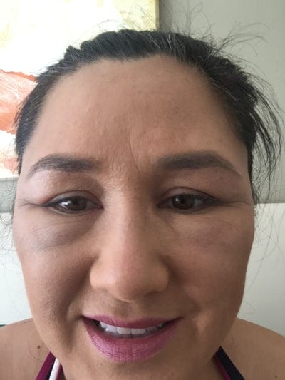 Corticosteroid, kháng sinh và tiêm triamcinolone trong phù malar