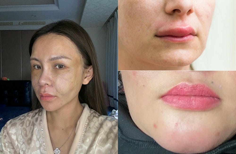 Ai phù hợp và ai không nên tiêm filler hốc mắt?