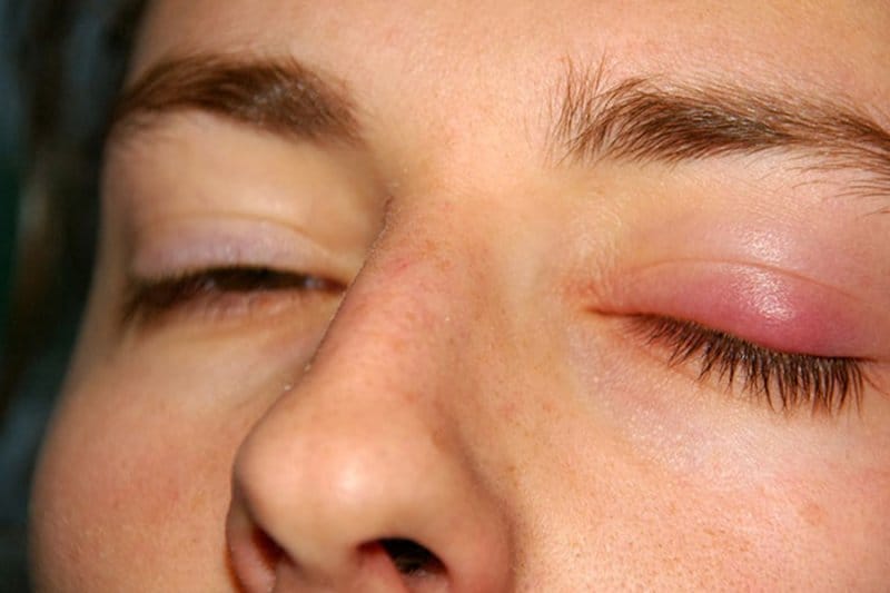 Khi nào sưng cảnh báo tắc mạch do filler? Dấu hiệu biến chứng nặng