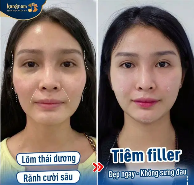 An toàn tiêm filler: biến chứng nào đáng lo và cách xử trí?