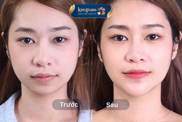 Có bằng chứng lâm sàng nào về xử trí biến chứng và hiệu quả filler?